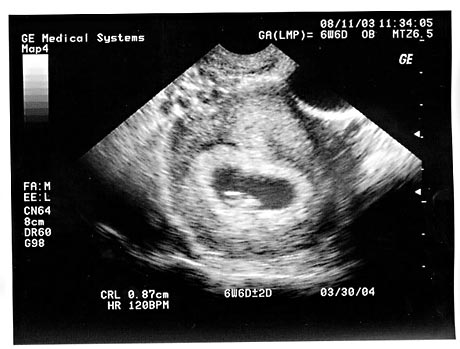 in the ultrasound:  where's the breathing, thinking, sentient human being?