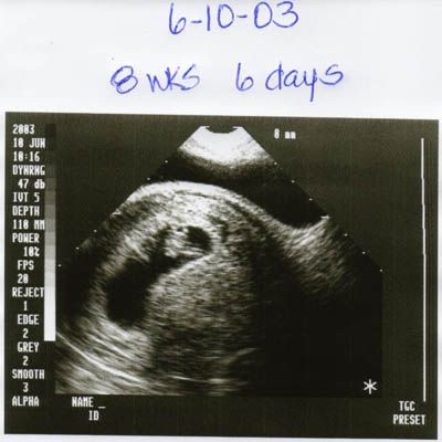 1ld.ultrasound.9wks.jpg