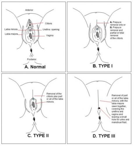 circumcised female