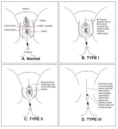 If diagrams of female genitals (with or without clitoris) offend you don't look at this image.