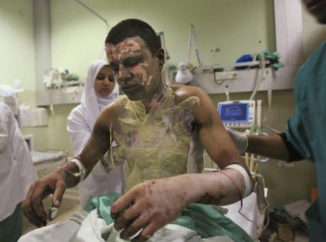 White Phosphurous Victim Gaza